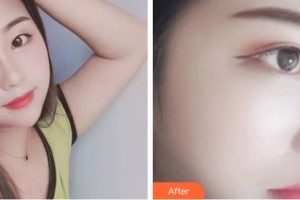 咸寧韓美醫(yī)療美容醫(yī)院鄢潮海整形價(jià)格表附熱拉提案例展示