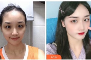 咸寧韓美醫(yī)療美容醫(yī)院廖海洋整形價(jià)格表附埋線提升案例展示