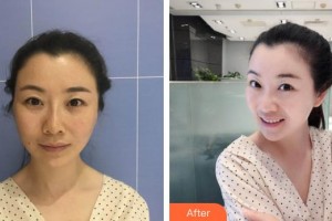 咸寧市中心醫(yī)院醫(yī)學(xué)美容中心周朝暉整形價(jià)格表附埋線提升案例展示