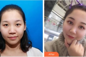 咸寧愛爾眼科醫(yī)院黃玉嬋整形價(jià)格表附眼部綜合案例展示