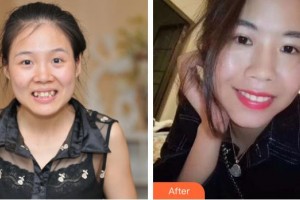 咸寧民生中山口腔醫(yī)院潘小青整形價(jià)格表附自鎖托槽矯正案例展示