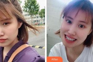 咸寧市第一人民醫(yī)院口腔科吳細(xì)霞整形價(jià)格表附金屬托槽矯正案例展示