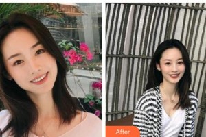 咸寧市第一人民醫(yī)院口腔科何小林整形價(jià)格表附金屬托槽矯正案例展示