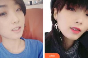 咸寧民生中山口腔醫(yī)院許炎標整形價格表附金屬托槽矯正案例展示