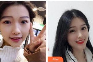 咸寧民生中山口腔醫(yī)院畢云昌整形價(jià)格表附牙齒隱形矯正案例展示