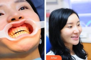 咸寧市第一人民醫(yī)院口腔科鎮(zhèn)榮軍整形價格表附金屬托槽矯正案例展示