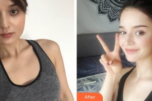 孝感華美醫(yī)療美容門診部王志軍整形價格表附埋線提升案例展示