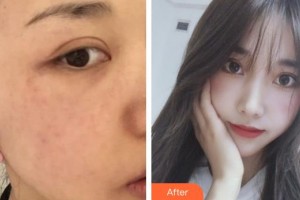 孝感仁愛醫(yī)院美容整形中心涂忠駿整形價(jià)格表附激光美膚激光案例展示