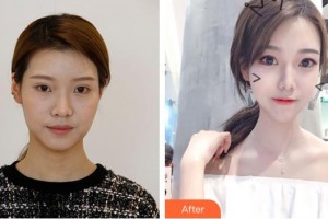 孝感天妃醫(yī)療美容門診部柳肖整形價(jià)格表附埋線提升例展示