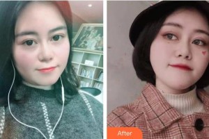 孝感歐陽整形美容診所嚴(yán)飛整形價(jià)格表附埋線提升案例展示