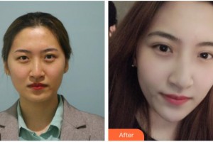 孝感愛爾眼科醫(yī)院桂芬整形價(jià)格表附埋線雙眼皮案例展示