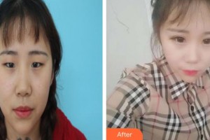孝感愛爾眼科醫(yī)院胡寶珍整形價格表附切開雙眼皮案例展示