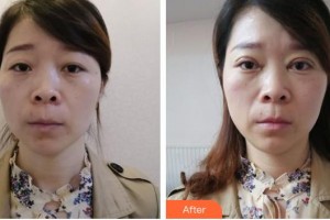 孝感愛爾眼科醫(yī)院葉剛整形價格表附切開雙眼皮案例展示