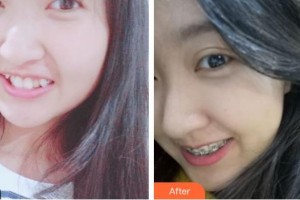 孝感城中口腔門診楊雷整形價格表附金屬托槽矯正案例展示