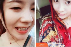 孝感君雅口腔門診李周勝整形價(jià)格表附牙齒隱形矯正案例展示