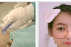 孝感君雅口腔門診劉心整形價格表附隱形托槽矯正案例展示