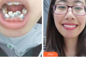 鄂州中山口腔醫(yī)院夏敬軍整形價(jià)格表附金屬托槽矯正案例展示