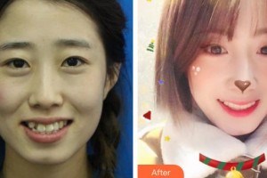 鄂州中山口腔醫(yī)院黃琪整形價(jià)格表附金屬托槽矯正案例展示