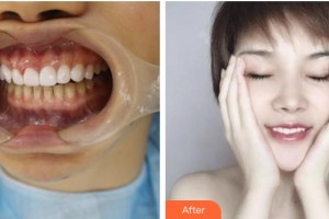 鄂州中山口腔醫(yī)院葛麗娟整形價(jià)格表附美白貼片案例展示