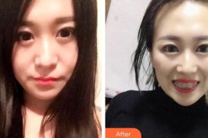 鄂州中山口腔醫(yī)院龔嵐整形價(jià)格表附金屬托槽矯正案例展示