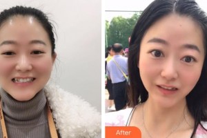 鄂州中山口腔醫(yī)院蔣松波整形價(jià)格表附牙齒隱形矯正案例展示