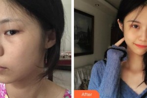 鄂州愛爾眼科醫(yī)院張杰整形價(jià)格表附眼部綜合案例展示