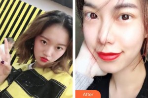 鄂州愛爾眼科醫(yī)院胡悅整形價(jià)格表附切開雙眼皮案例展示