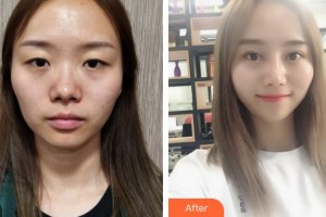 鄂州愛爾眼科醫(yī)院楊亞利整形價(jià)格表附上眼瞼去脂案例展示