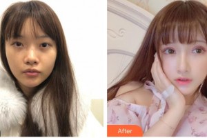 武漢兒童醫(yī)院向施紅整形價(jià)格表附開內(nèi)眼角案例展示