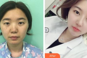 武漢市第八醫(yī)院眼科黃昭昭整形價(jià)格表附眼部綜合案例展示