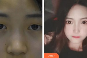 武漢艾格眼科醫(yī)院張捷整形價(jià)格表附定點(diǎn)雙眼皮案例展示