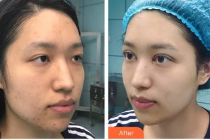 武漢艾格眼科醫(yī)院金小琴整形價(jià)格表附開內(nèi)眼角案例展示