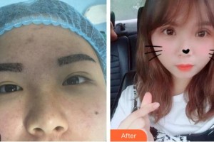 武漢艾格眼科醫(yī)院段淯平整形價(jià)格表附切開雙眼皮案例展示