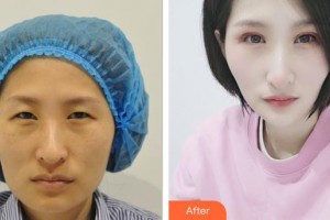 武漢艾格眼科醫(yī)院呂學(xué)峰整形價(jià)格表附眼部修復(fù)案例展示