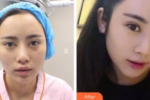 武漢艾格眼科醫(yī)院趙霞整形價(jià)格表附眼部綜合案例展示