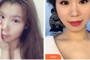 武漢艾格眼科醫(yī)院熊士波整形價(jià)格表附切開雙眼皮案例展示