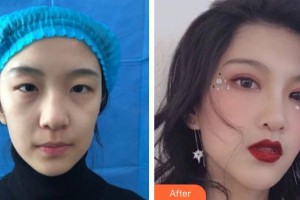武漢艾格眼科醫(yī)院胡耀整形價(jià)格表附切開雙眼皮案例展示