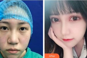 武漢艾格眼科醫(yī)院袁媛整形價(jià)格表附切開雙眼皮案例展示