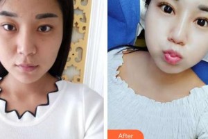 武漢艾格眼科醫(yī)院黃齊斌整形價(jià)格表附切開雙眼皮案例展示