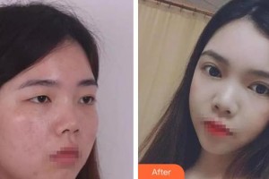 武漢艾格眼科醫(yī)院戴青整形價(jià)格表附定點(diǎn)雙眼皮案例展示