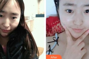 武漢艾格眼科醫(yī)院黃鵬程整形價(jià)格表附眼部綜合案例展示