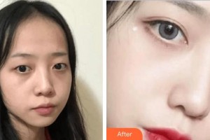 武漢艾格眼科醫(yī)院左健生整形價(jià)格表附切開雙眼皮案例展示