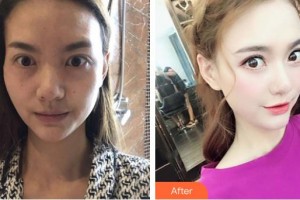 武漢艾格眼科醫(yī)院熊鳳珠整形價(jià)格表附眼部修復(fù)案例展示