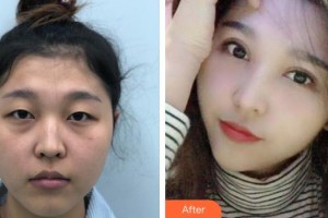 武漢艾格眼科醫(yī)院劉志光整形價(jià)格表附眼部綜合案例展示