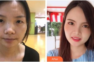 武漢艾格眼科醫(yī)院伍清香整形價(jià)格表附切開雙眼皮案例展示