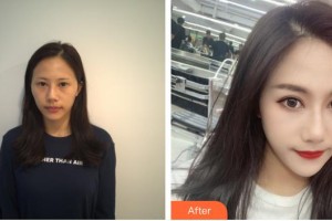 武漢艾格眼科醫(yī)院洪利整形價(jià)格表附眼部修復(fù)案例展示