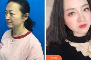 武漢艾格眼科醫(yī)院鄢俊杰整形價(jià)格表附切眉術(shù)案例展示