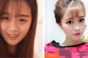 武漢艾格眼科醫(yī)院高天整形價(jià)格表附切開雙眼皮案例展示