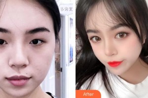 武漢艾格眼科醫(yī)院薩米爾整形價(jià)格表附開內(nèi)眼角案例展示