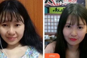 武漢佰視達(dá)眼科門診部張?chǎng)握蝺r(jià)格表附切開雙眼皮案例展示